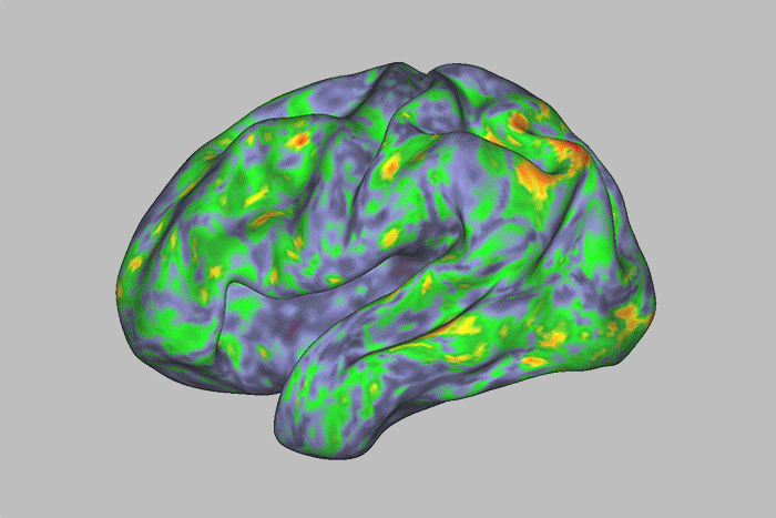 Heat map shows psilocybin destabilizing brain networks, paving the way for lasting stability.